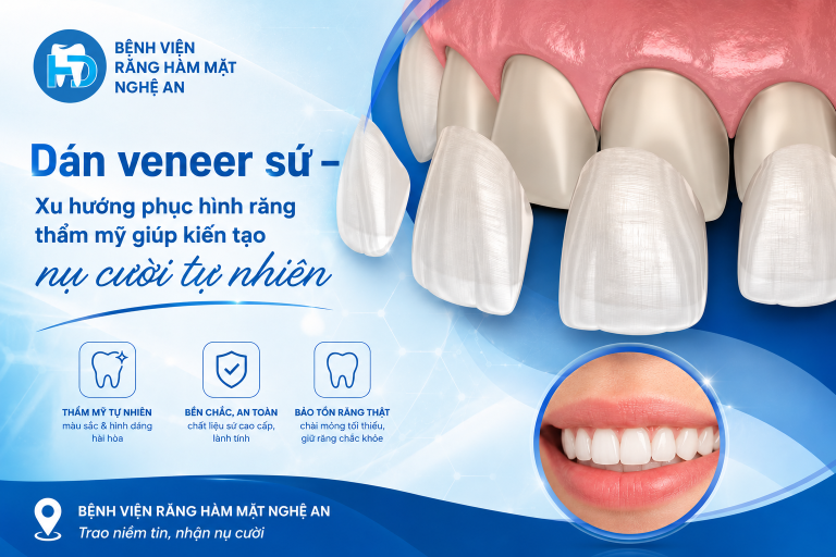 Dán veneer sứ