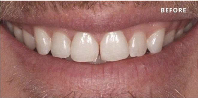 Hình ảnh Trước dán veneer
