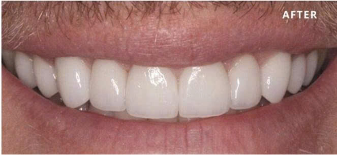 Hình ảnh Sau dán veneer