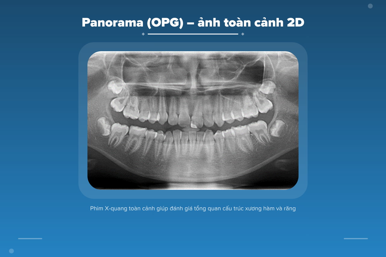 Hình ảnh chụp Panorama (OPG) toàn cảnh 2D trong nha khoa giúp đánh giá tổng quát răng và xương hàm.
