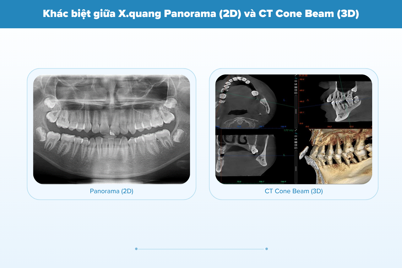 Khác biệt giữa X.quang Panorama (2D) và CT Cone Beam (3D)