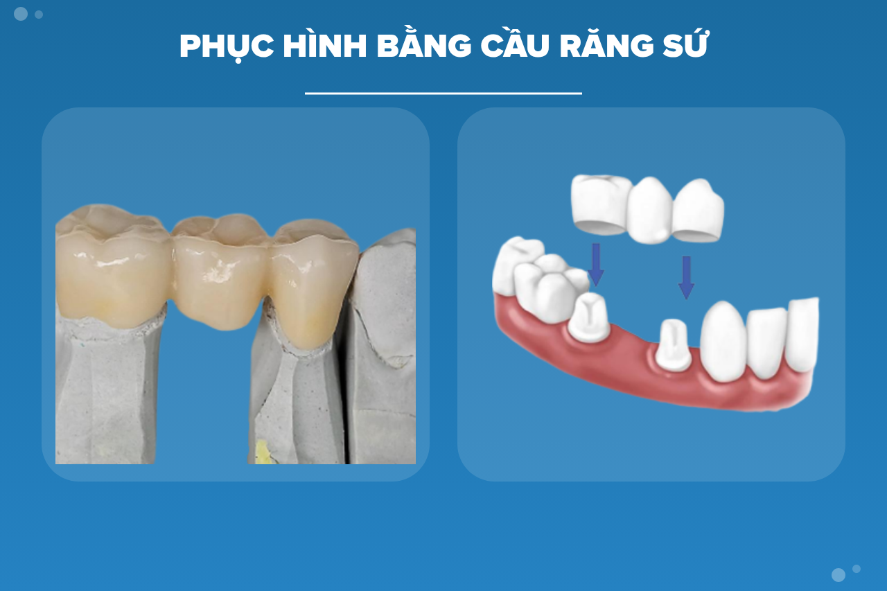 Phục hình bằng cầu răng sứ