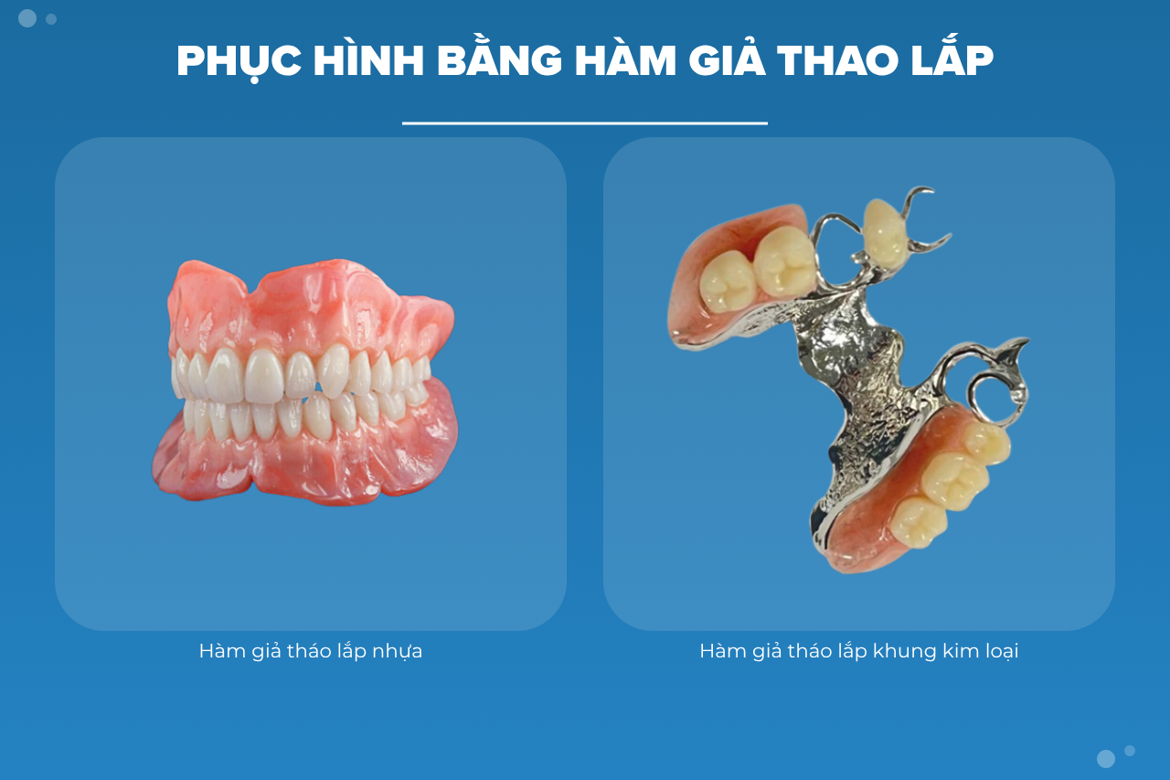 Phục hình bằng hàm giả thao lắp 