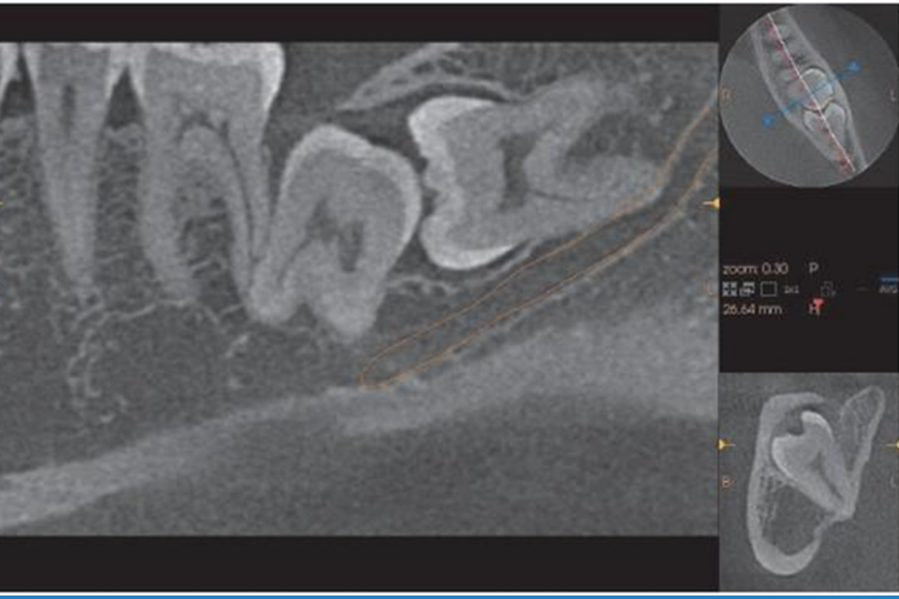 Ảnh thực tế trên CBCT